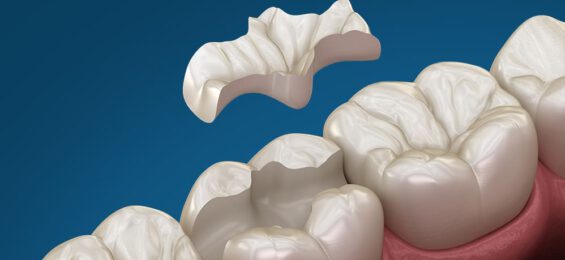 Keramik-Inlay-blau-1